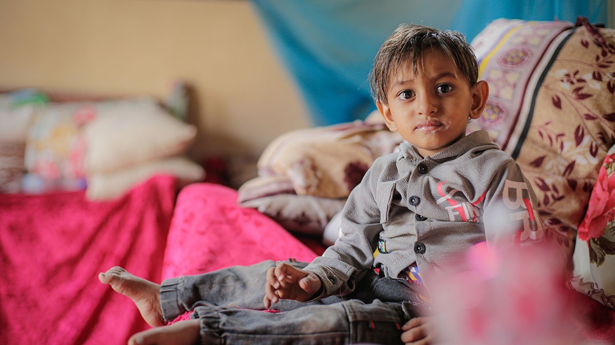 Mangelernährtes Kind im Jemen
