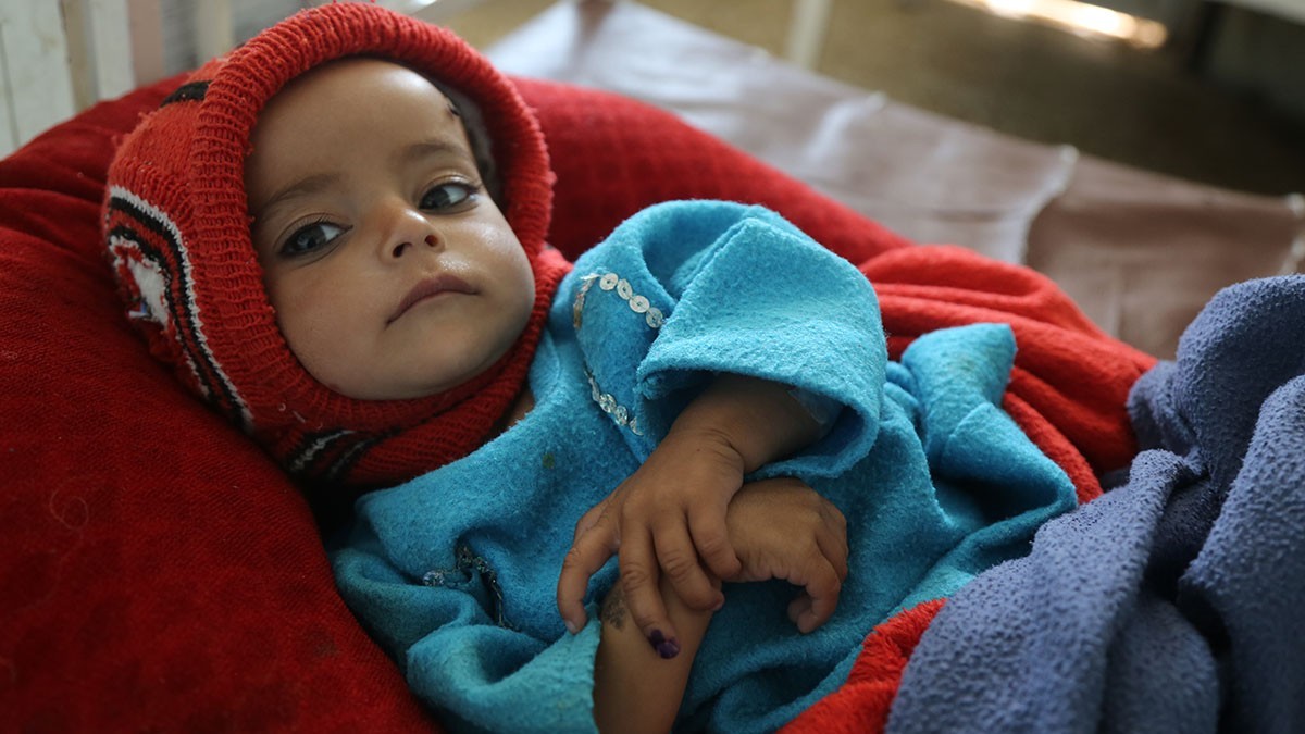 Mangelernährtes Kind in Afghanistan