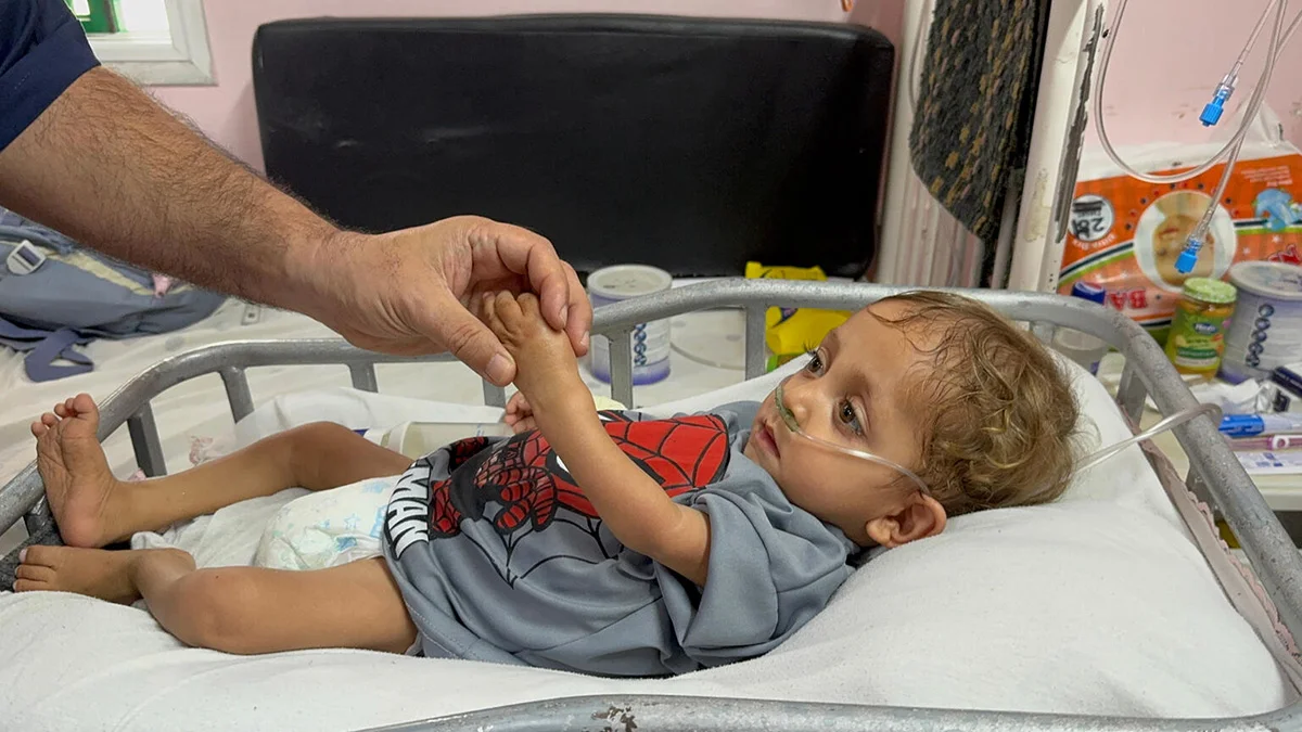 Ein mängelernährtes Kind liegt in einem Krankenhausbett und hält die Hand eines Erwachsenen