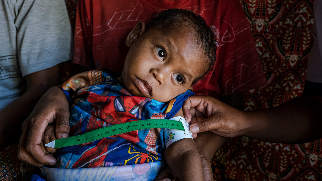 Bambino malnutrito in Indonesia.