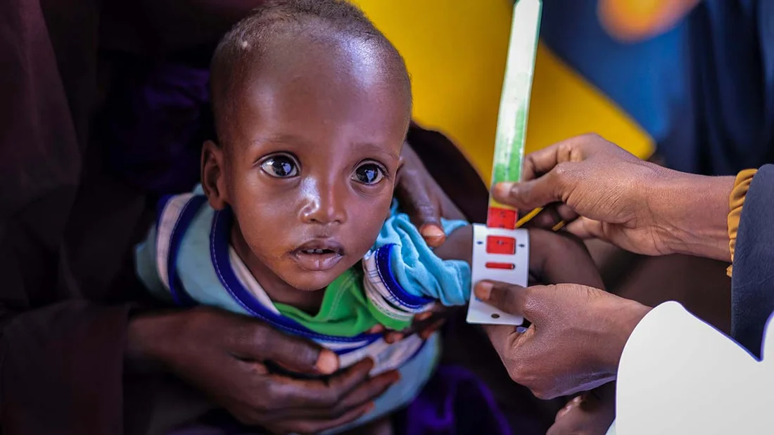 Bub in Somalia wird auf Mangelernährung untersucht