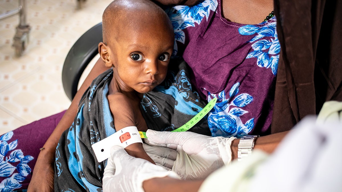 Unterernährtes Kind in Somalia 